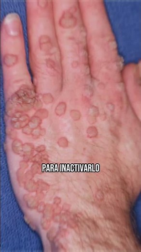 ¿Cómo distinguir molusco contagioso del VPH?