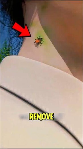 Never Remove a Tick Like This! 😨