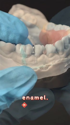 Precision Partial & Single-Tooth Solution with Ball-Catch Retention and Shade-Matching Clasp