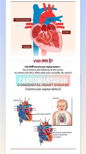 Ventricular Septal Defect🫀