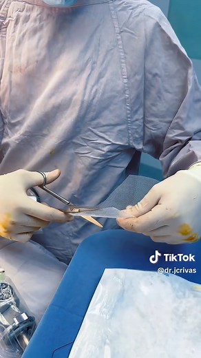 Mallas para hernias: Beneficios y seguridad explicados