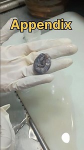 Appendix specimen grossing 🧐 | #histopathology #appolitics #appendicitis #appendixsurgery #appendix