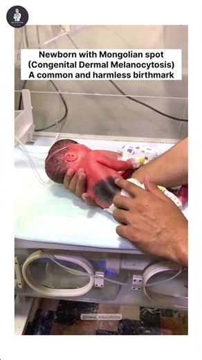 Newborn with Mongolian spot Congenital Dermal Melanocytosis #mongolianspot #birthmark #shortsfeed