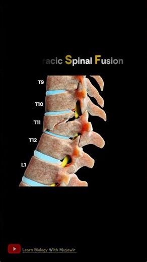 Thoracic Spine Fusion in 3D | Medical Animation Short