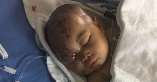 Baby attacked by raccoon