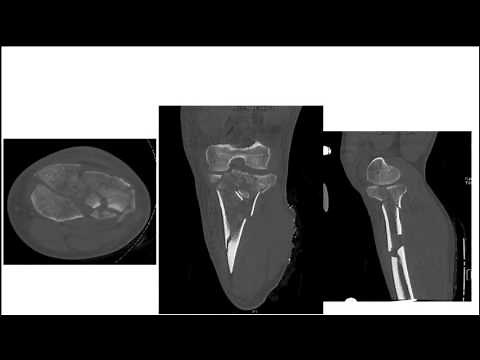 Tips to make us more successful with managing tibial plateau fractures