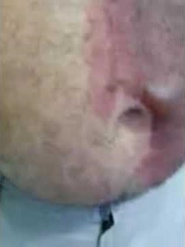 Second degree burn