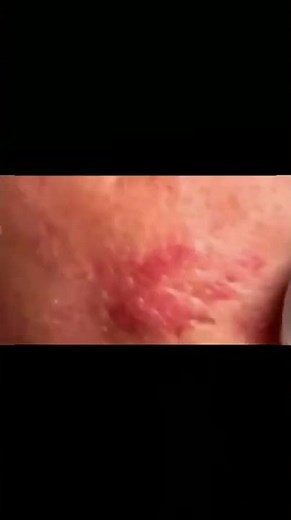 Best new pimple popping, cyst and blackhead extraction videos 2022 || Pimple time #12
