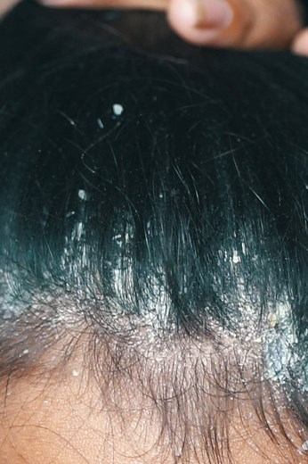 15K views · 68 reactions | Extreme Scalp Flakes | Dry Scalp Picking & Heavy Scratch Sounds ✨ #FlakyScalp #DandruffASMR #ScalpCleaning #ASMRTriggers #RelaxingASMR #ScalpCare | Franco Barrera | Facebook