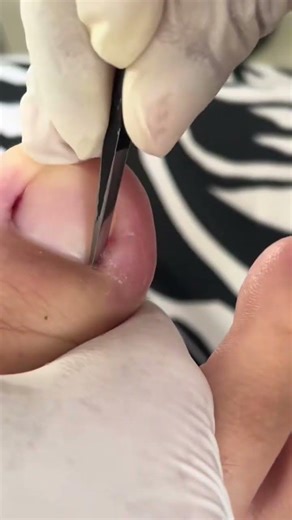 Technical is trim toenail Part 202 #pedicure #nailart #nails