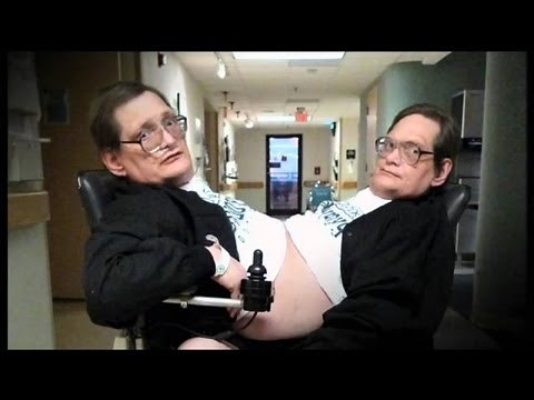 Conjoined Twins - Ronnie and Donnie Galyon