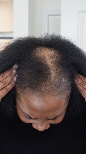 Tori Latise on Instagram: "Because alopecia could never stop my show!  . . . Drawstring ponytail by @freetress_braid"