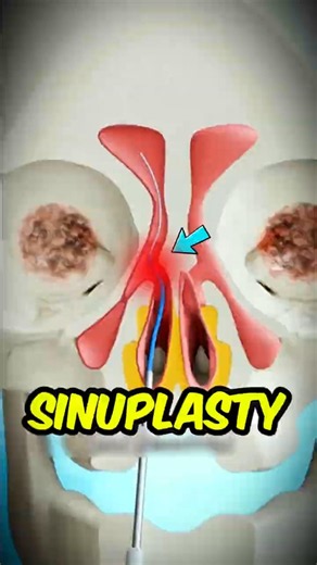 If You Ever Wondered How Doctors Open Blocked Sinuses 🎈😲