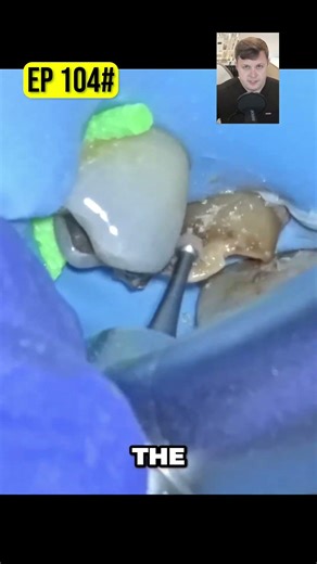 Advanced Ultrasonic Techniques for Tooth Preservation!