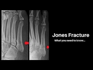 Jones Fractures