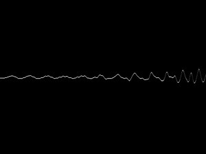Electron beam therapy is a kind of radiation therapy to treat... | Filo