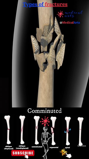 Types of fractures - Medical Arts