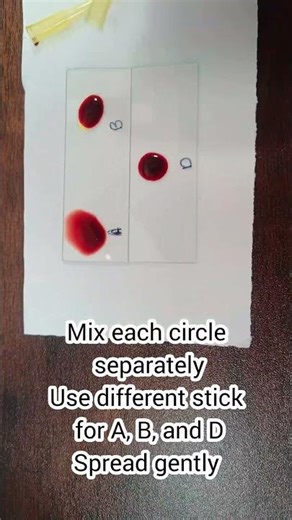 ABO&Rh Blood Grouping Slide Method|explained step-by-step #ABObloodgrouping#bloodgroupingslidemethod