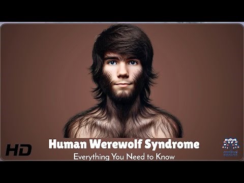 Human Werewolf Syndrome: The Real-Life Curse of Excessive Hair Growth