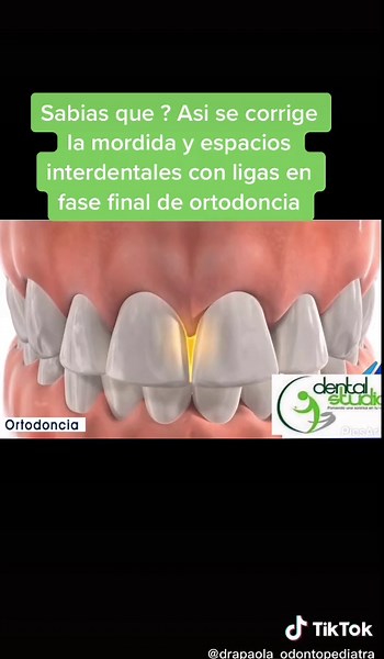 Correcting Bite and Interdental Spaces with Braces - Dental Orthodontic Process