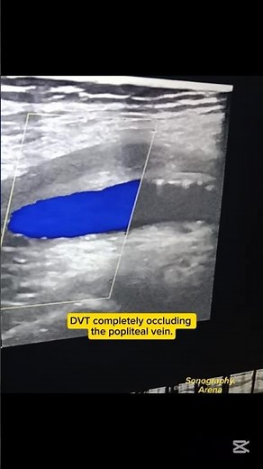 Deep Vein Thrombosis: Popliteal Vein Occlusion on Ultrasound.