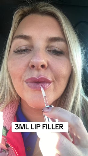 Transform Your Lips with 3ML Lip Filler