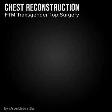 Chest Reconstruction - Female to Male - Before & After Pictures
