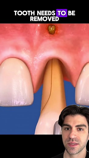 Replacing A BR0KEN Tooth #teeth #tooth #animation #dentist #dentalhygienist