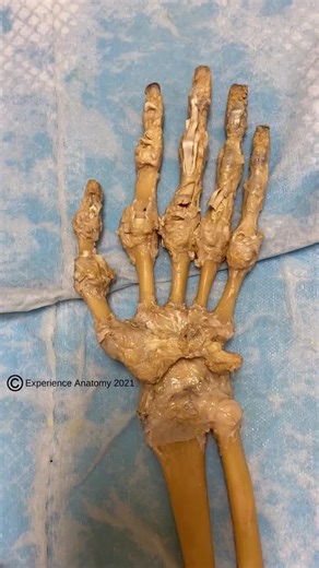 Check out yesterday's post to see the structures that pass through the carpal tunnel! The transverse carpal ligament is what forms the 'top' of the carpal tunnel. If you have severe enough carpal tunnel syndrome, a surgeon will incise (cut) this ligament to alleviate the pain caused by compression of the median nerve passing through the tunnel - and the main culprit causing weakness and pain. Anatomy lesson by @klausrachel #anatomy #experienceanatomy #bones #carpal #carpaltunnel #anatomyeducatio