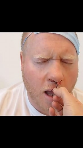 Medical Doctors on Instagram: "Removing the nasal packing after the sinus surgery 🤧 Nasal packing is the placement of an intranasal device that applies constant local pressure to the nasal septum. Nasal packing works by (1) direct pressure; (2) consequent reduction of mucosal irritation, which decreases bleeding; and (3) clot formation surrounding the foreign body, which enhances pressure. #doctorreels #doctors #medicalreels #ent #rhinoplasty #plasticsurgery #medicalschool"