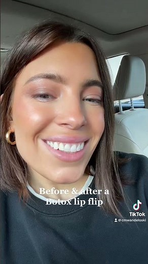 Botox lip flip before and after