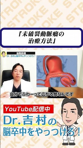 未破裂脳動脈瘤の治療方法 #脳卒中 #脳出血 #脳動脈瘤 #未破裂動脈瘤 #ステント併用コイル塞栓術 #くも膜下出血 #兵庫医科大学 #医学生 #研修医 #脳外科