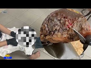 🔥 Severe Jigger Invasion – Hidden Layers of Damage Revealed! #DJ144