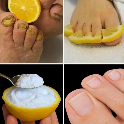 Get rid of Foot fungus with Lemon! I didn't believe it | Creative Action