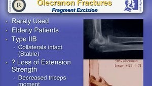 Fractures of the Ulna (Including Monteggia) Not So Simple