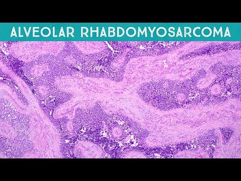 Alveolar rhabdomyosarcoma (explained in 5 minutes) (pediatric pathology USMLE rare disease)