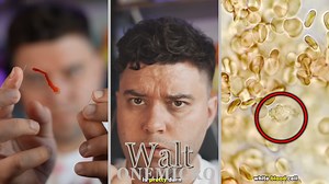 White Blood Cells Attack Giant Parasite Worm!