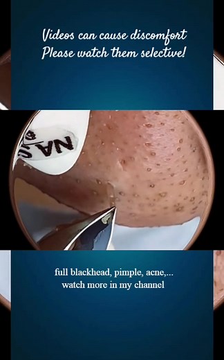 Pimple Satisfying on TikTok