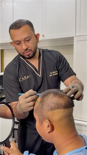 This Hairline Design Will Age Perfectly #hairtransplant #hairrestoration