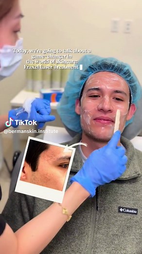 This patient was ready to say goodbye to his deep acne scars and hello to smooth, clear skin. ✨ We’re thrilled to be a part of his skincare journey and help him achieve his goals. Watch as he undergoes a Fraxel laser treatment to help resurface his skin and reduce the appearance of scarring. Provider: @aesthetics_thaorn 💙🌟 📍 Los Altos, CA Want to start your skincare journey? Click the link in our bio to meet with one of our many skilled Dermatologists!👨‍⚕️👩‍⚕️ #acnescars #fraxel #skincarejo