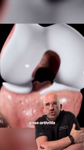 Cory Calendine MD on Instagram: "📸 Knee Arthritis in 3D: the Kellgren-Lawrence grading scheme is the most- widely used/accepted standard for diagnosis of radiographic or x-ray #osteoarthritis: Grade 0: No #radiographic features of #arthritis present Grade 1: Doubtful joint space narrowing (JSN) + possible osteophytic lipping. Grade 2: The presence of definite osteophytes + possible JSN on anteroposterior weight-bearing #kneexray Grade 3: Multiple osteophytes, definite JSN, sclerosis, possible b