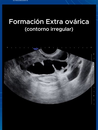 Reto O-RADS: ¿Cuál es la respuesta correcta?