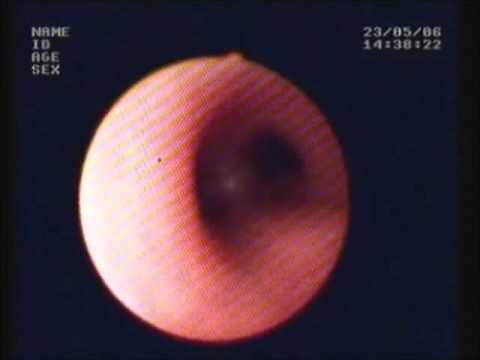 Bronchoscopy, Flexible fibre optic bronchoscope, procedure