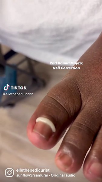 Transform Your Toenails with Onyfix Correction System