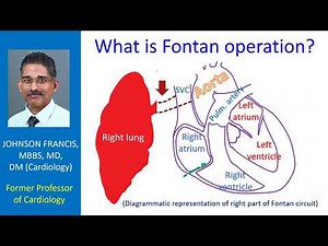 What is Fontan operation?