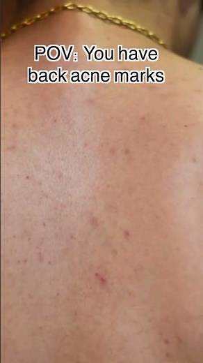 How to prevent back acne? | Dr. Sarin |