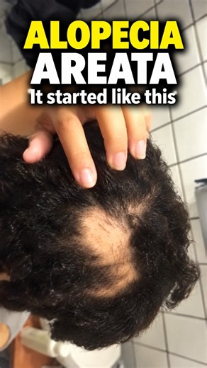 Can You Reverse Alopecia Areata?😳 Watch This Before You Panic