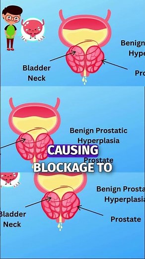 Why Can't Some People Pee Easily?