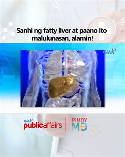 #PinoyMD: Ano nga ba ang sanhi sa pagkakaroon ng sakit na fatty liver at paano ito malulunasan? Alamin ang mga detalye sa video na ito. | GMA Public Affairs
