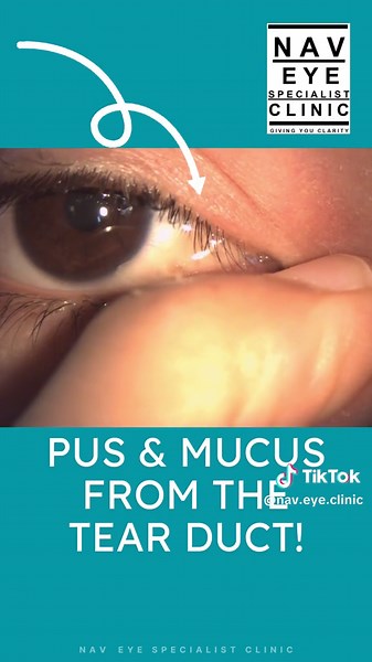 Nanah dari mata! Blocked tear drainage / longkang air mata sumbat!